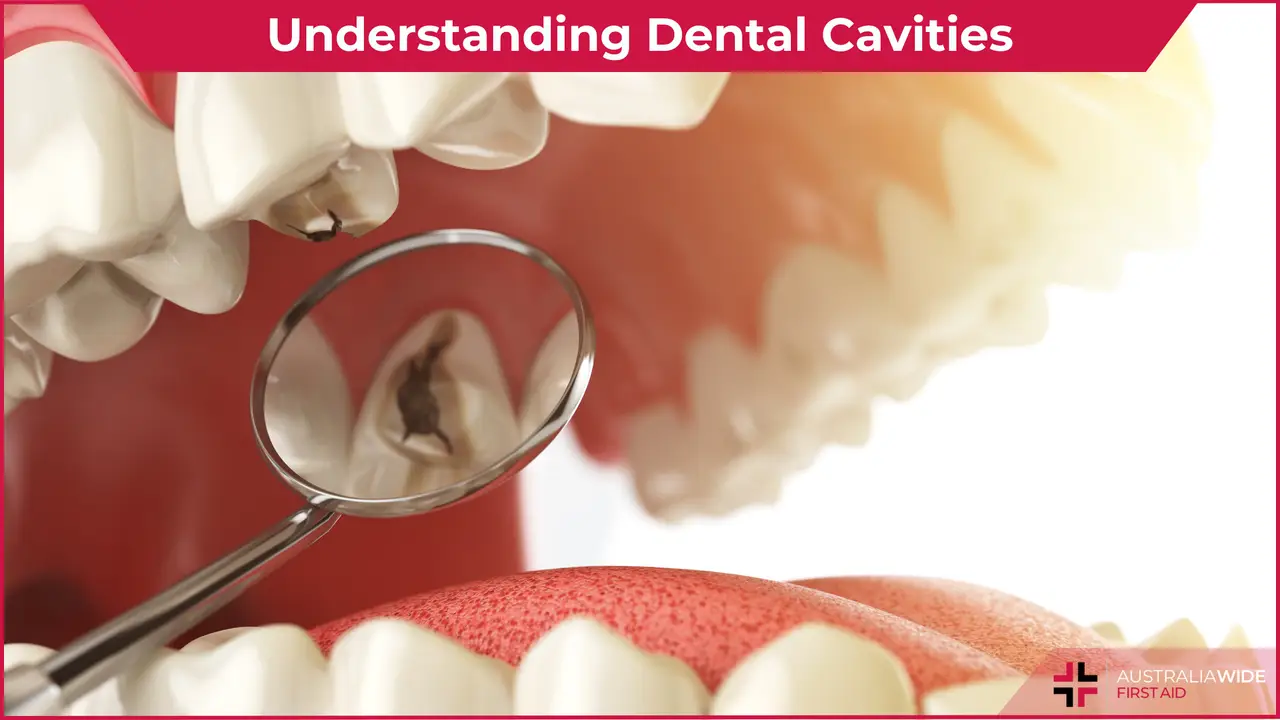 Understanding Dental Cavities